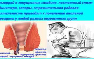 Лечение трещин заднего прохода лучшими суппозиториями