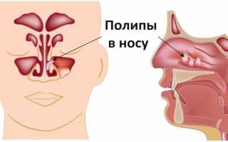 Полипы в гайморовой пазухе: причины, симптомы и лечение