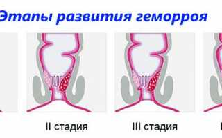 Как выглядят на фото шишки геморроя?
