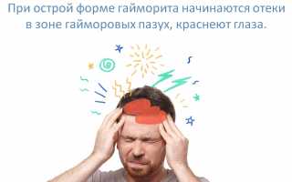 Как болит голова при гайморите: как определить симптомы у взрослого