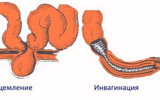 Причины появления крови из заднего прохода у ребенка
