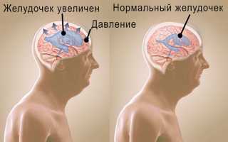 Гидроцефалия головного мозга