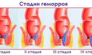 Как распознать внутренний геморрой?