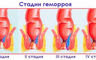 Как распознать внутренний геморрой?