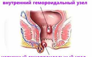 Как решить проблему геморроя у беременных женщин