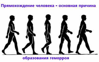 Что нужно знать о геморрое: симптомы и лечение