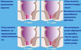 Как определить развитие геморроя 4 степени по фото