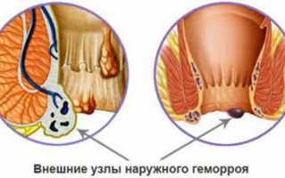Откуда в заднем проходе появилась шишка?