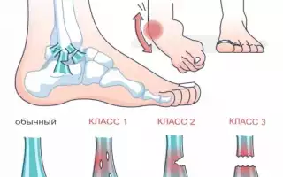 Что делать при растяжении связок и мышц ноги