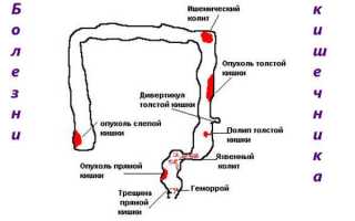 Лечение заболеваний ЖКТ – эффективные средства