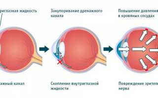 Глазное давление: симптомы и лечение в домашних условиях