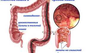 Полипы прямой кишки – удалять или лечить консервативно