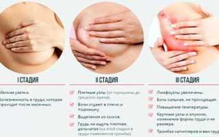 Мастопатия молочной железы – как и чем лечить, признаки и симптомы