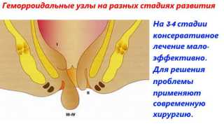 Способы лечения геморроя на 4 стадии развития