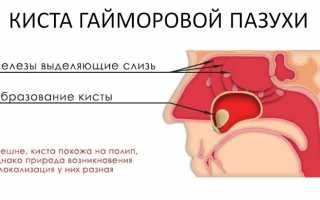 Киста пазухи носа МКБ-10: киста гайморовых пазух у взрослых