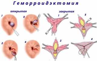 Методы радикальной хирургии – геморроидэктомия