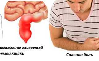 Как распознать и лечить язву прямой кишки