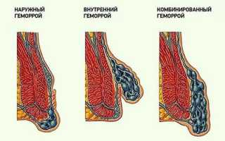 Основные симптомы и способы лечения геморроя