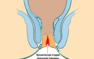 Анальная трещина: эффективное лечение