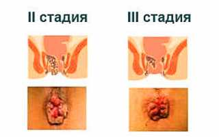 Все способы лечения геморроя