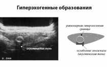 Гипоэхогенное образование с четкими контурами на УЗИ