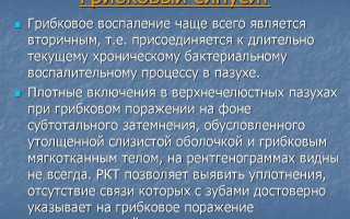 Вирусный гайморит: симптомы и лечение у взрослых и детей