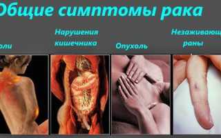 Этапы развития рака прямой кишки