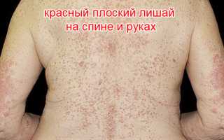 Красный плоский лишай: причины, симптомы, лечение