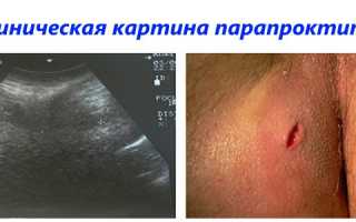 Как бороться с парапроктитом после операции