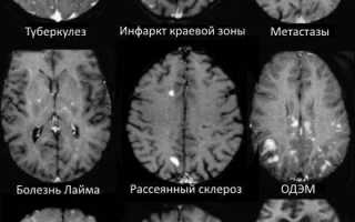 Виды, причины, лечение очаговых изменений мозга сосудистого характера