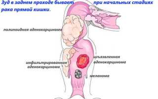 Что делать, когда зудит задний проход?