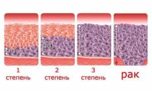 Дегенеративные изменения эпителия шейки матки