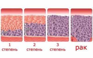 Дегенеративные изменения эпителия шейки матки