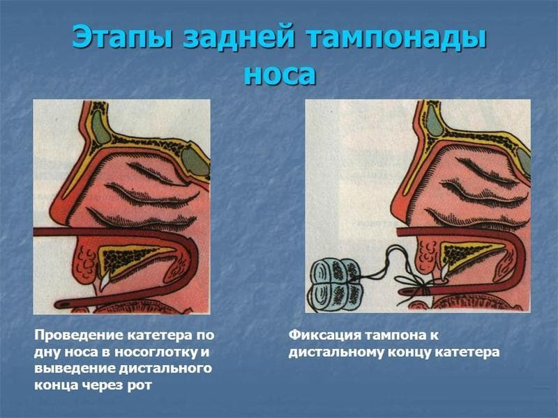 _
